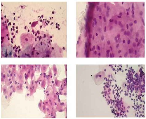 inflammatory cells on pap smear.